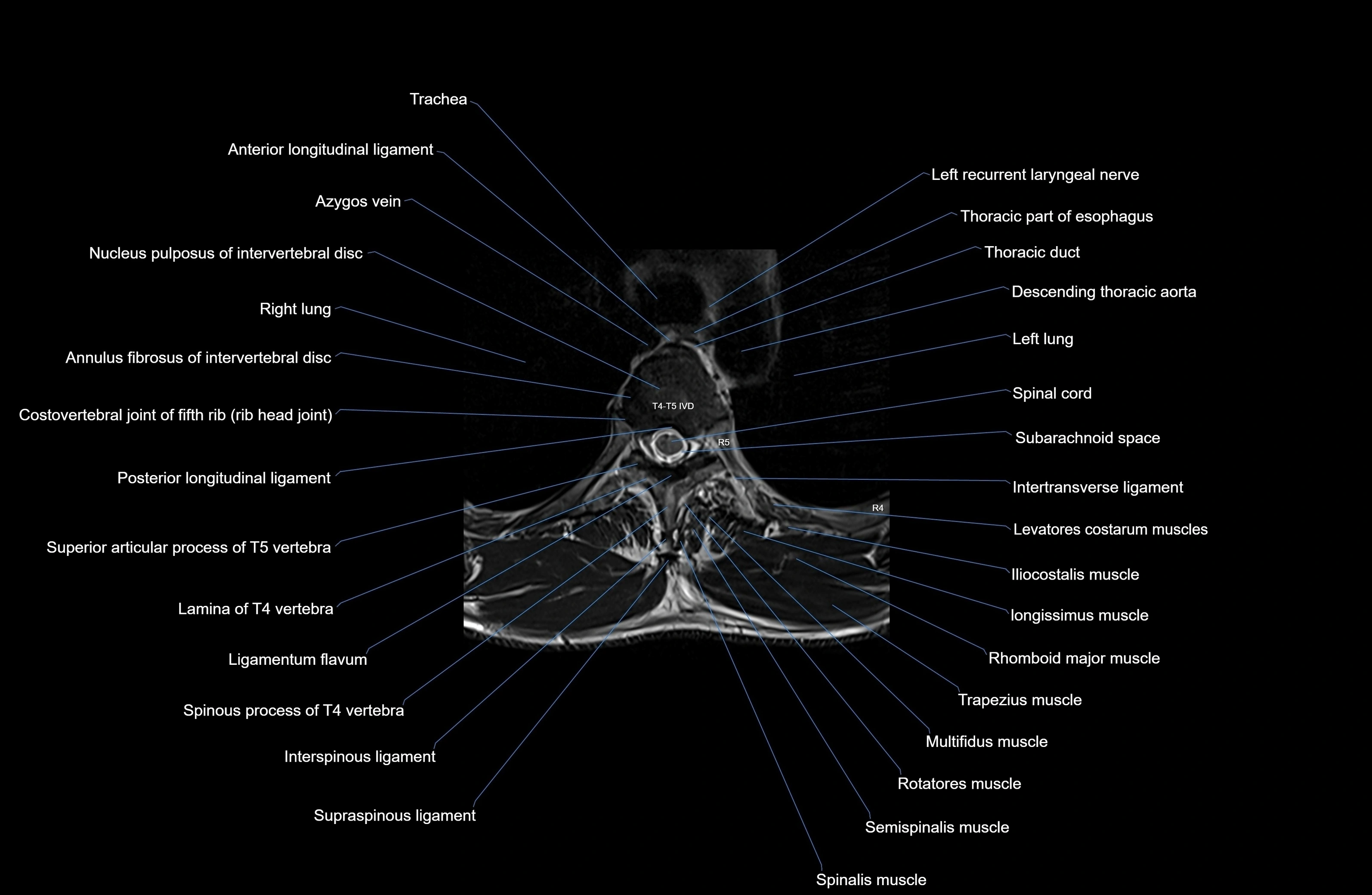 MRI thoracic spine axial  cross sectional anatomy 3T radiology  image-img-00001-00029.webp